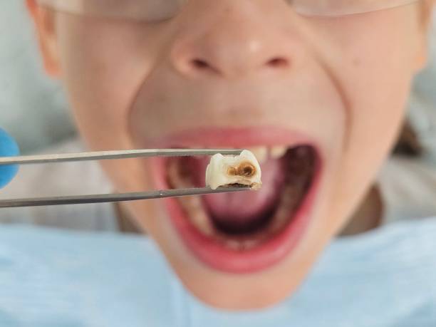 Best Emergency Dental Extractions in Gibbsboro, NJ