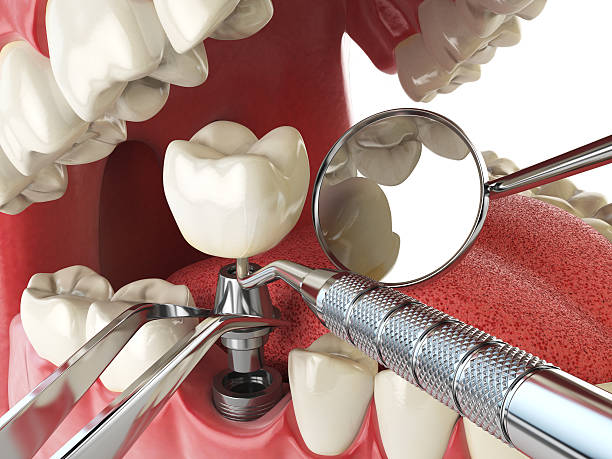 Best Emergency Dentist for Lost Fillings or Crowns in Gibbsboro, NJ